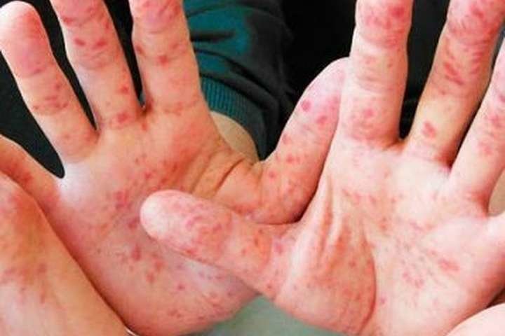 МОЗ України закликає керівників області і міста оперативно врегулюв... МОЗ України закликає керівників області і міста оперативно врегулювати перерозподіл вакцин